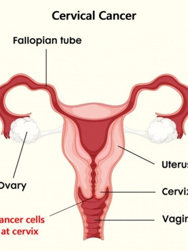 India Launches Vaccine Against Cervical Cancer