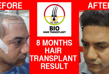 Best hair transplant in chennai