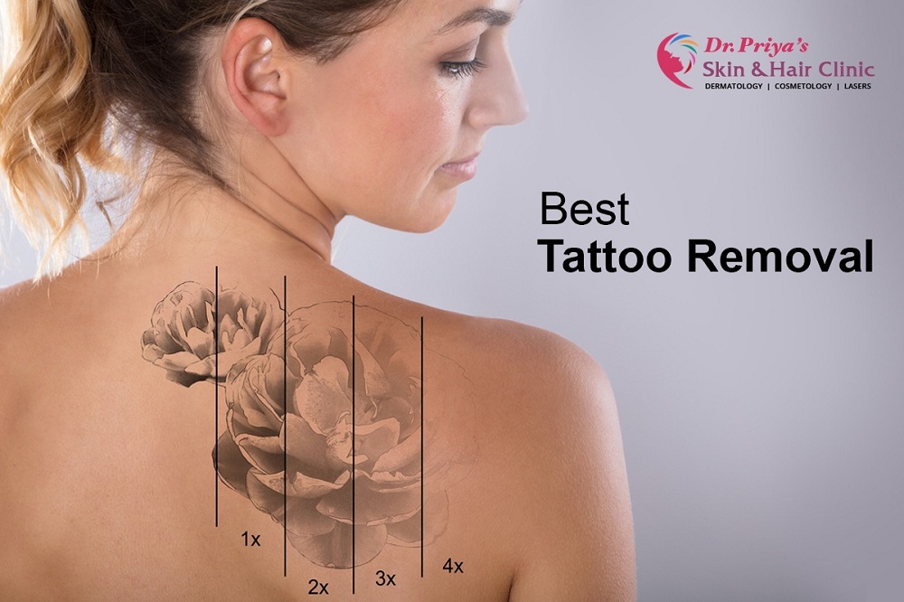 Best Laser Tattoo Removal in Bangalore – Guaranteed Results