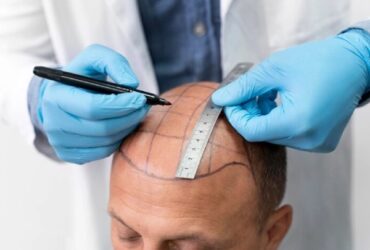 Hair Transplant In Delhi NCR