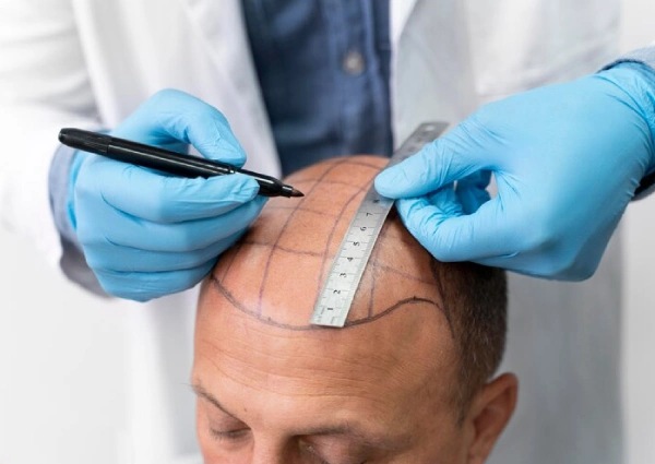 Hair Transplant In Delhi NCR